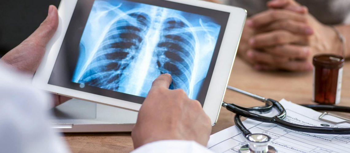 Quels sont les symptômes du cancer du poumon ?